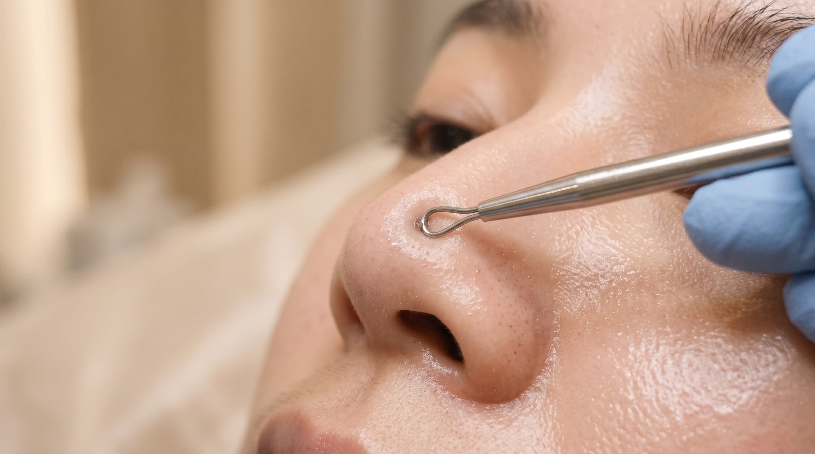 ProClear Skin Treatment